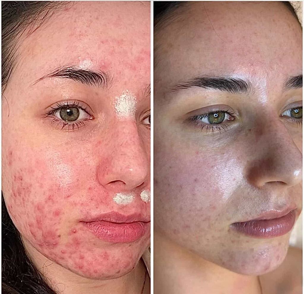 Výsledky karbonového peelingu - léčba akné Před a Po