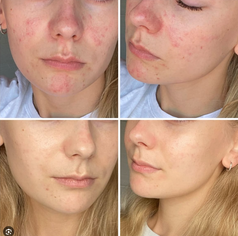 Výsledky karbonového peelingu Před a Po