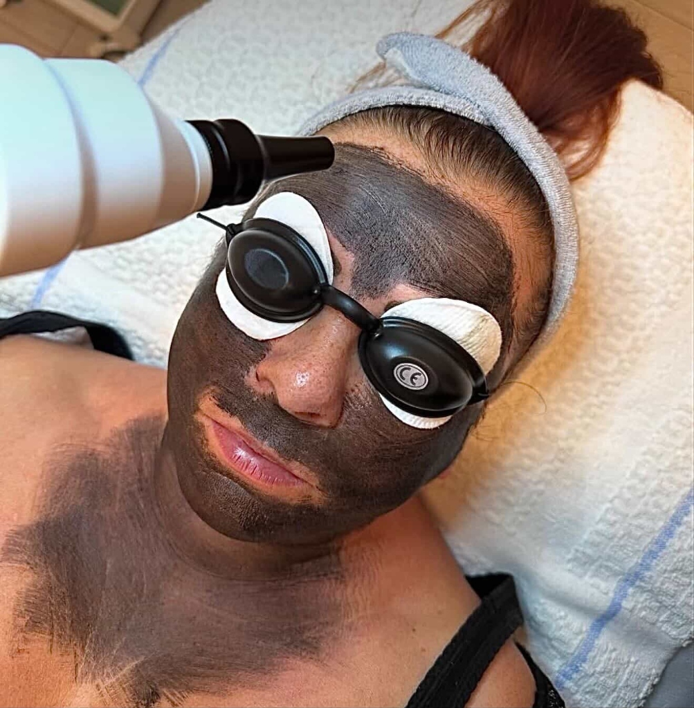 Aplikace laseru při karbonovém peelingu