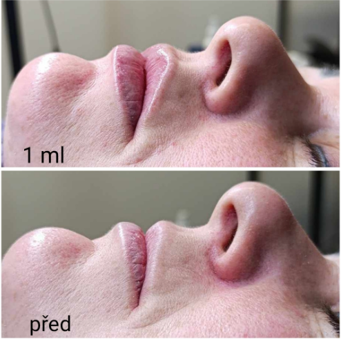 Hyaluron Pen - Výsledky