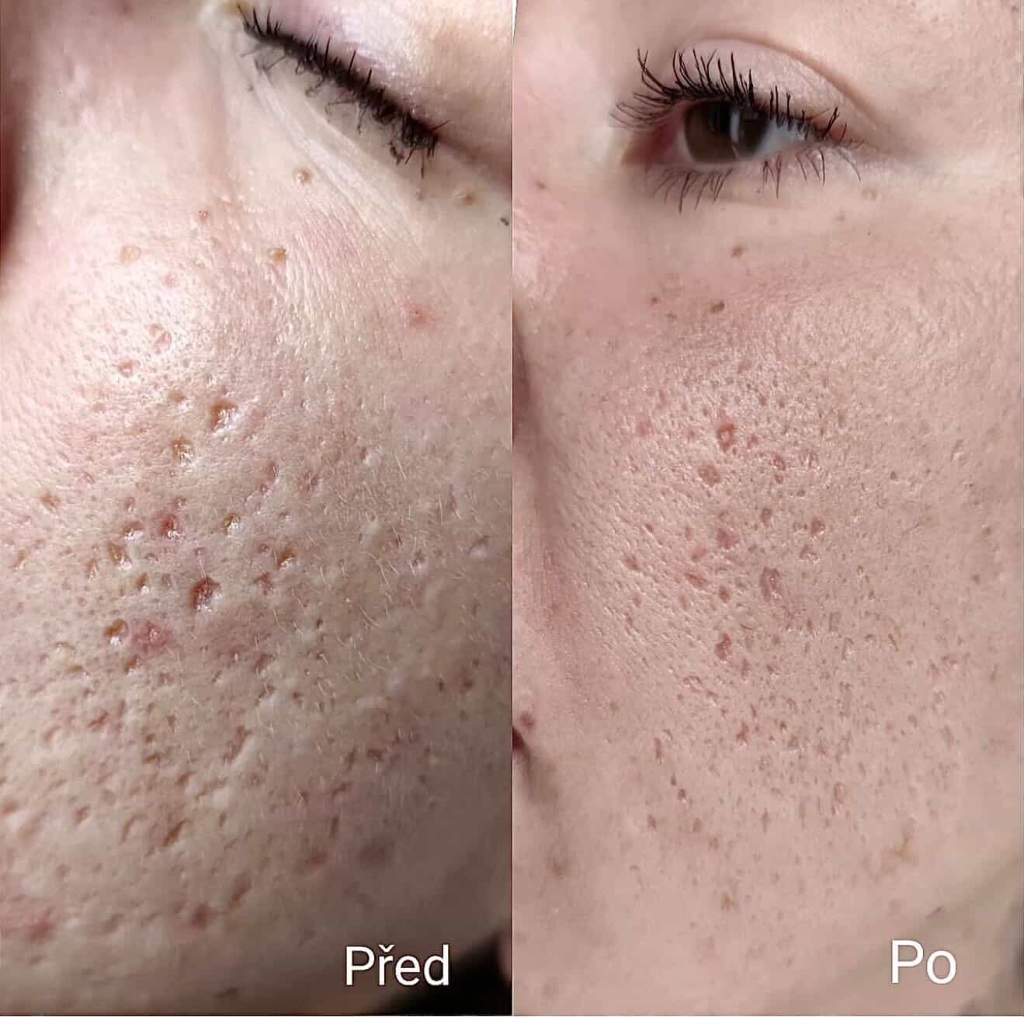 Výsledky mezoterapie Před a Po - póry