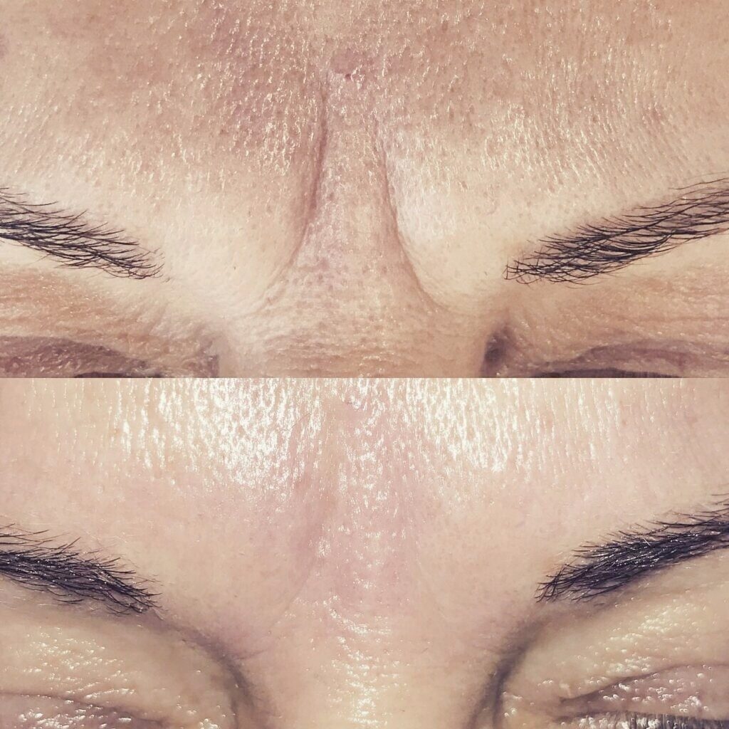 Výsledky mezoterapie Před a Po