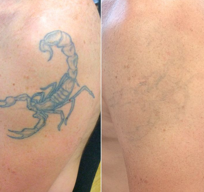 Výsledky odstranění tetování