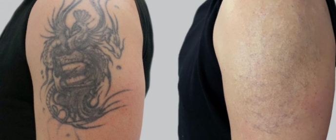 Odstranění tetování