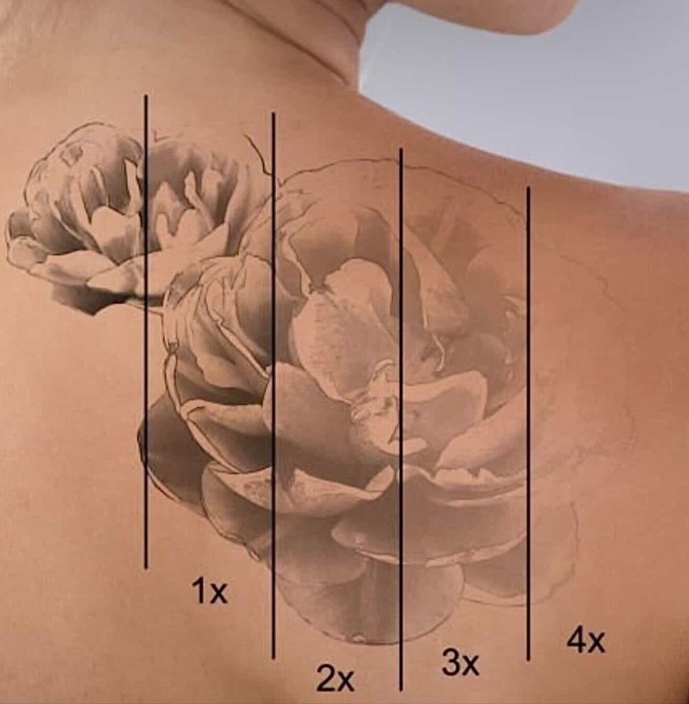 Průběh odstranění tetování po jednotlivých sezeních